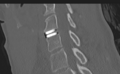Cervical disc replacement (Radiopaedia 37383-39205 Sagittal bone window 45).png