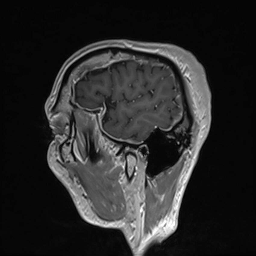 Cervical dural CSF leak on MRI and CT treated by blood patch (Radiopaedia 49748-54995 G 2).jpg