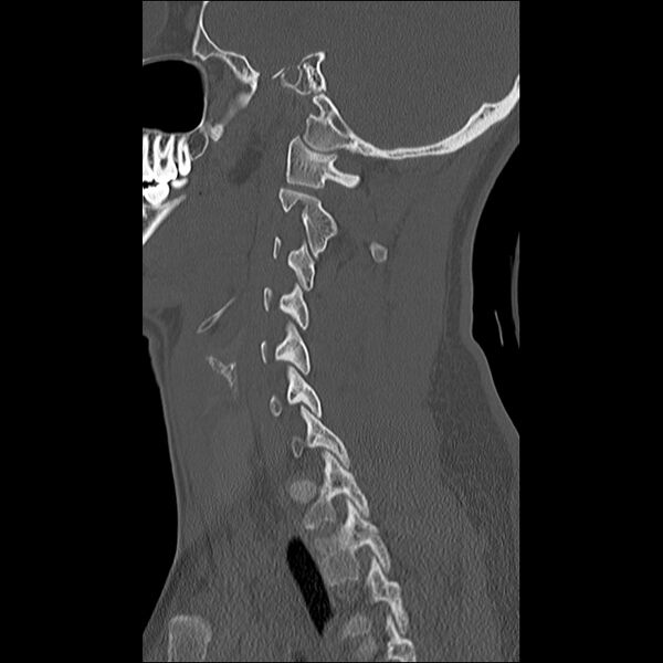 File:Cervical facet fracture and anterior discoligamentous injury (Radiopaedia 32139-33083 Sagittal bone window 10).jpg