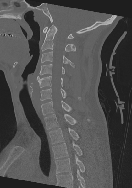 File:Cervical intercalary bone (Radiopaedia 35211-36748 Sagittal bone window 42).png