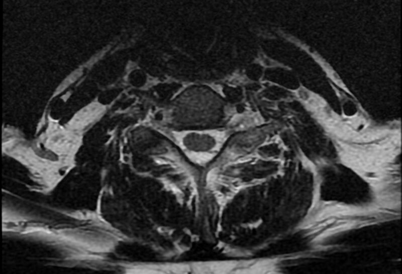 File:Cervical schwannoma (Radiopaedia 72399-82934 Axial T2 18).jpg