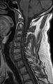 Cervical schwannoma (Radiopaedia 72399-82934 Sagittal T1 7).jpg