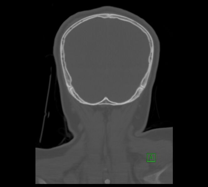 File:Cervical spine fracture - hyperflexion injury (Radiopaedia 66184-75364 Coronal bone window 22).jpg