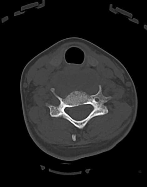 File:Cervical tuberculous spondylitis (Radiopaedia 39149-41365 Axial bone window 35).png