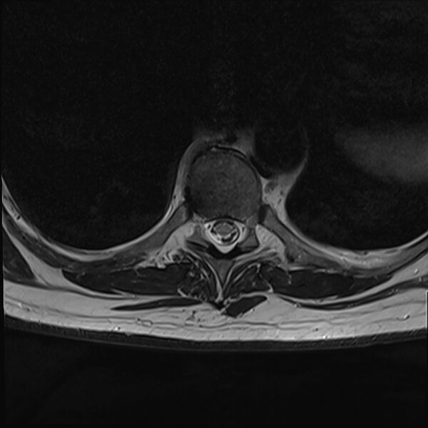 File:Cervical tumor-like myelopathy due to Type V dAVF (Radiopaedia 82461-96604 D 34).jpg