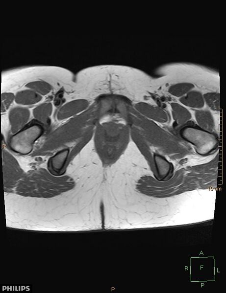 File:Cesarian scar endometriosis (Radiopaedia 68495-78066 Axial T1 24).jpg