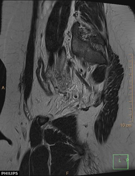 File:Cesarian scar endometriosis (Radiopaedia 68495-78066 Sagittal T2 23).jpg