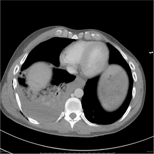 File:Chest and abdomen multi-trauma (Radiopaedia 26294-26426 bone window 9).jpg