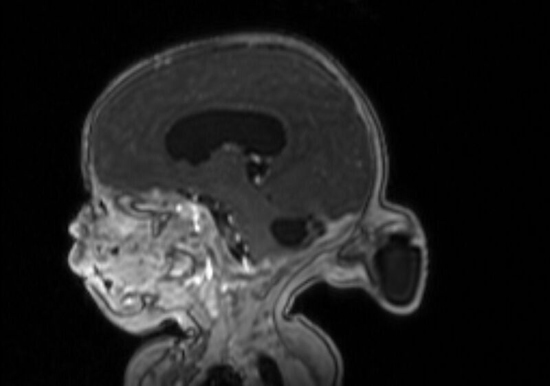 File:Chiari III malformation with occipital encephalocele (Radiopaedia 79446-92559 Sagittal T1 C+ mpr 40).jpg