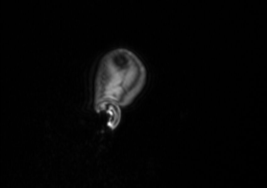 Chiari III malformation with occipital encephalocele (Radiopaedia 79446-92559 Sagittal T1 C+ mpr 62).jpg