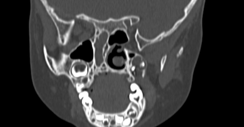 Choanal atresia (Radiopaedia 51295-56972 Coronal bone window 60).jpg