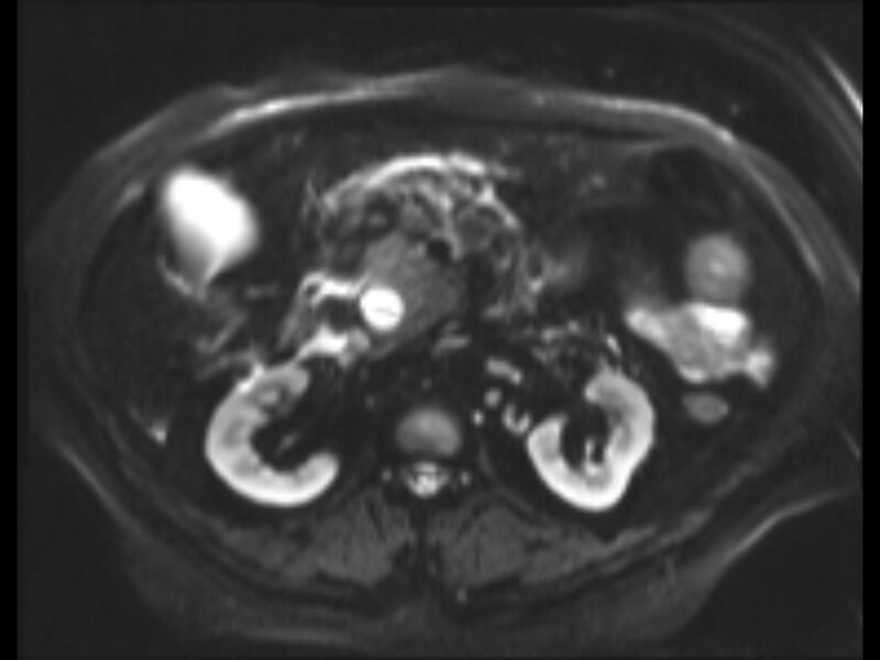 File:Choledocholithiasis causing intrahepatic biliary duct dilation (Radiopaedia 39908-42369 Axial T2 SPAIR 10).jpg
