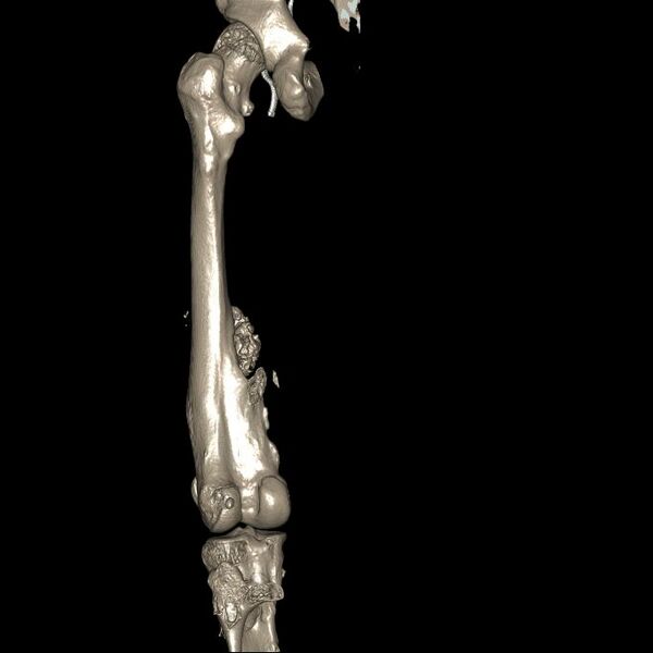 File:Chondrosarcoma arising from exostosis (Radiopaedia 59996-67507 3D Reconstruction 5).jpg