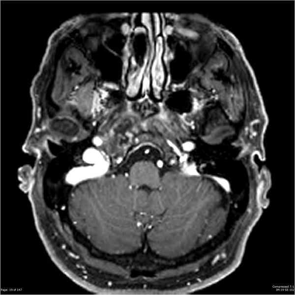 File:Chondrosarcoma of skull base- grade II (Radiopaedia 40948-43654 Axial T1 C+ 7).jpg