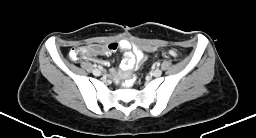 Choriocarcinoma liver metastases (Radiopaedia 74768-85766 A 160).jpg