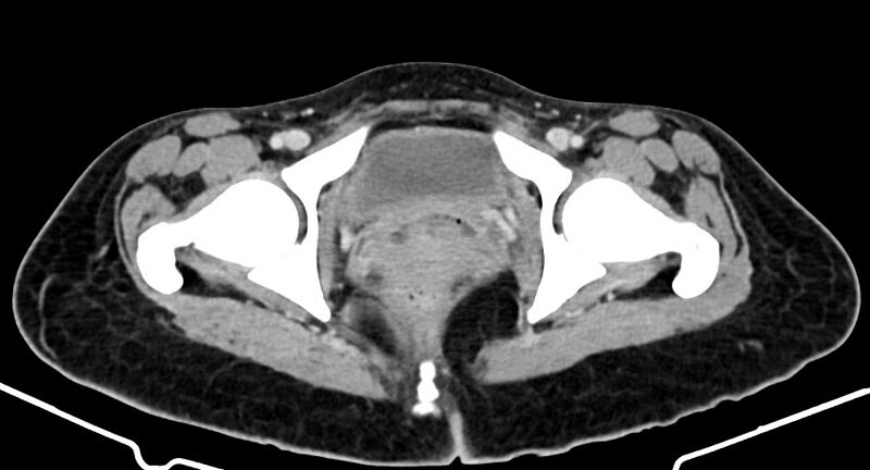 File:Choriocarcinoma liver metastases (Radiopaedia 74768-85766 A 198).jpg