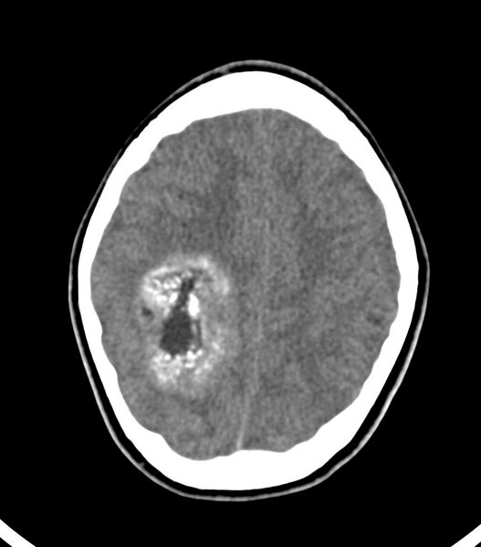 File:Choroid plexus carcinoma (Radiopaedia 91013-108552 Axial non-contrast 45).jpg