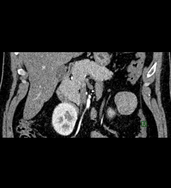 File:Chromophobe renal cell carcinoma (Radiopaedia 84286-99573 E 17).jpg