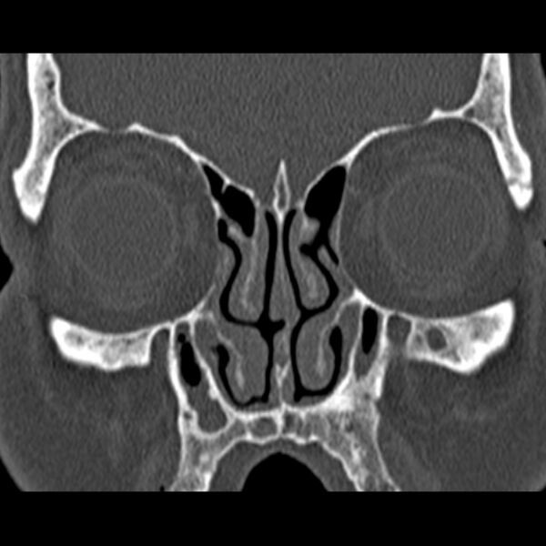 File:Chronic maxillary sinusitis (Radiopaedia 27879-28116 Coronal bone window 18).jpg