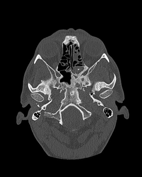 File:Chronic maxillary sinusitis caused by a foreign body (Radiopaedia 58521-65676 Axial bone window 194).jpg