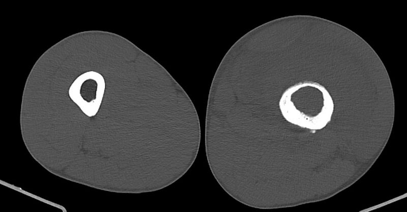 File:Chronic osteomyelitis (with sequestrum) (Radiopaedia 74813-85822 Axial non-contrast 100).jpg
