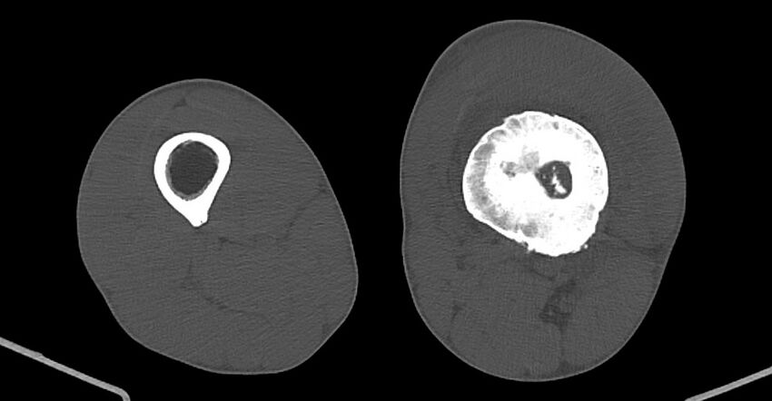 Chronic osteomyelitis (with sequestrum) (Radiopaedia 74813-85822 Axial non-contrast 133).jpg