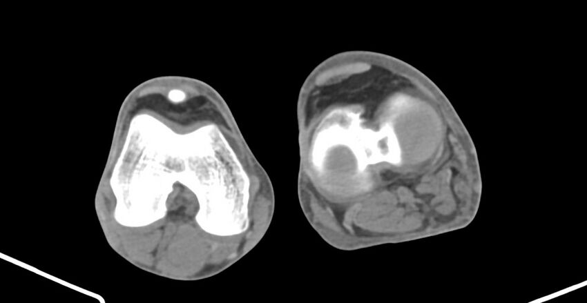 Chronic osteomyelitis (with sequestrum) (Radiopaedia 74813-85822 D 190).jpg