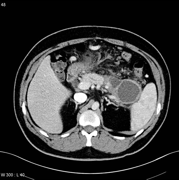 File:Chronic pancreatitis and pseudocysts (Radiopaedia 6724-7935 B 6).jpg