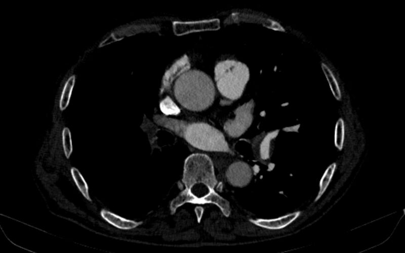 File:Chronic pulmonary embolism (Radiopaedia 91241-108843 B 100).jpg