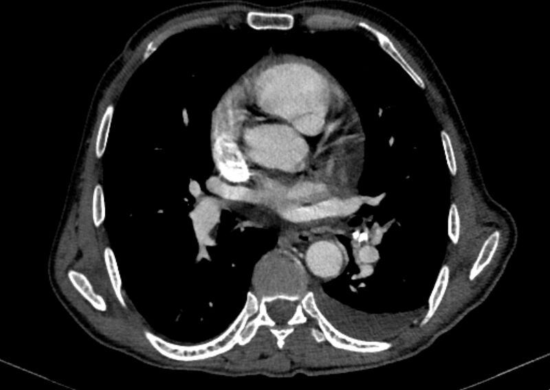 File:Chronic pulmonary embolism with bubbly consolidation (Radiopaedia 91248-108850 C+ arterial phase 81).jpg