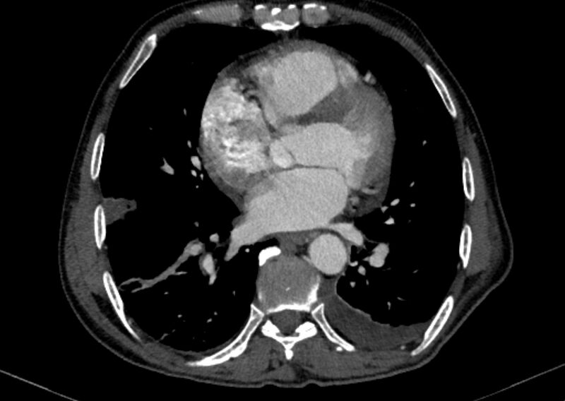 File:Chronic pulmonary embolism with bubbly consolidation (Radiopaedia 91248-108850 C+ arterial phase 95).jpg