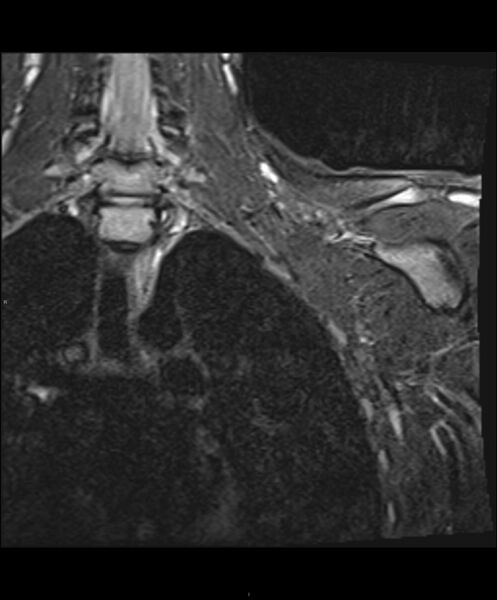 File:Chronic reactive multifocal osteomyelitis (CRMO) - clavicle (Radiopaedia 56406-63114 Coronal STIR 6).jpg