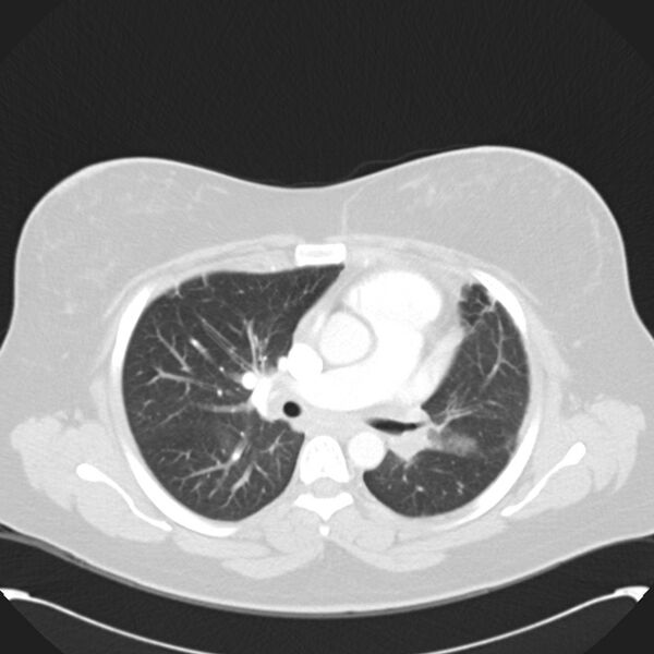 File:Chronic thromboembolic pulmonary hypertension (CTEPH) (Radiopaedia 74597-85531 Axial lung window 23).jpg
