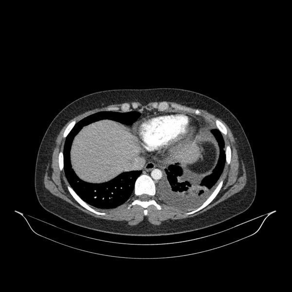 File:Chronic thromboembolic pulmonary hypertension (CTEPH) (Radiopaedia 74597-85532 Axial C+ CTPA 41).jpg