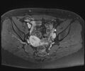 Class II Mullerian duct anomaly- unicornuate uterus with rudimentary horn and non-communicating cavity (Radiopaedia 39441-41755 Axial T1 fat sat 55).jpg
