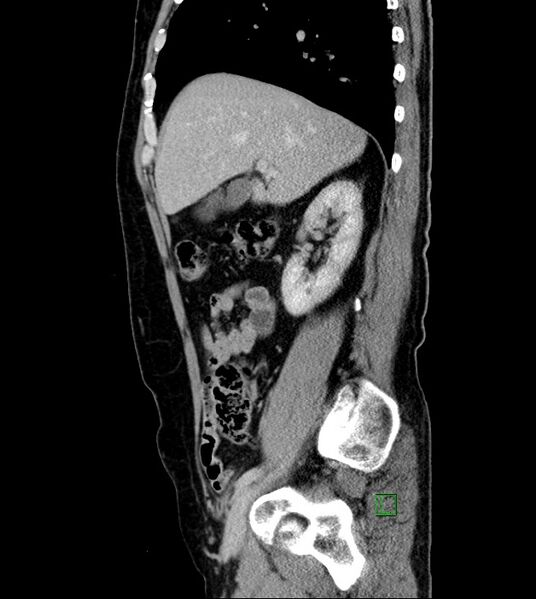 File:Clear cell renal cell carcinoma (Radiopaedia 85006-100539 G 43).jpg