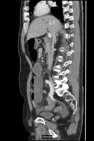 File:Closed loop bowel obstruction and ischemia (Radiopaedia 86959-103180 C 39).jpg