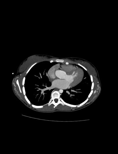 File:Coarctation of the aorta (Radiopaedia 27458-27657 D 15).jpg
