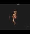 Coarctation of the aorta (Radiopaedia 43373-46729 3D reconstruction 36).jpg