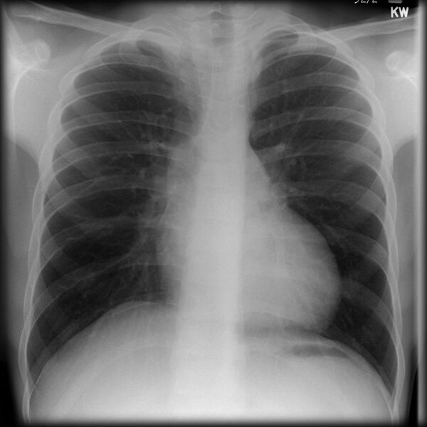 File:Coarctation of the aorta (Radiopaedia 6289-7690 Frontal 1).jpg