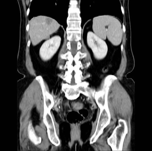 File:Colon carcinoma with hepatic metastases (Radiopaedia 29477-29961 B 31).jpg
