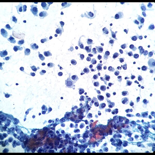 File:Melanoma (cytology) (Radiopaedia 79416).jpeg