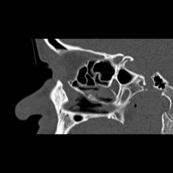 File:Nasal septal perforation (Radiopaedia 25030-25289 Sagittal bone window 11).jpg