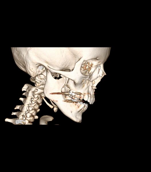 File:Nasoorbitoethmoid fracture (Radiopaedia 90044-107205 3D VRT 4).jpg