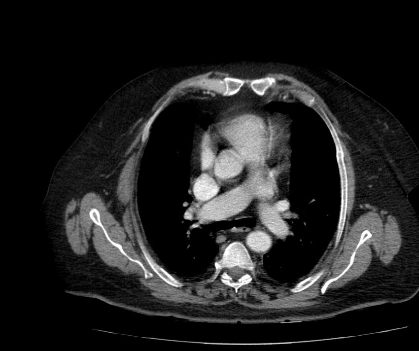 Nephroptosis with inguinal hernia containing perirenal fat (Radiopaedia 56632-63391 C 2).jpg