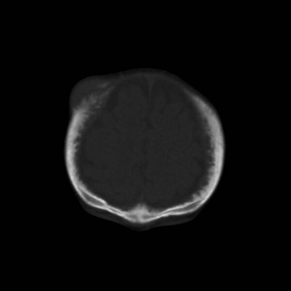 File:Neuroblastoma with skull metastases (Radiopaedia 30326-30958 Coronal bone window 9).jpg