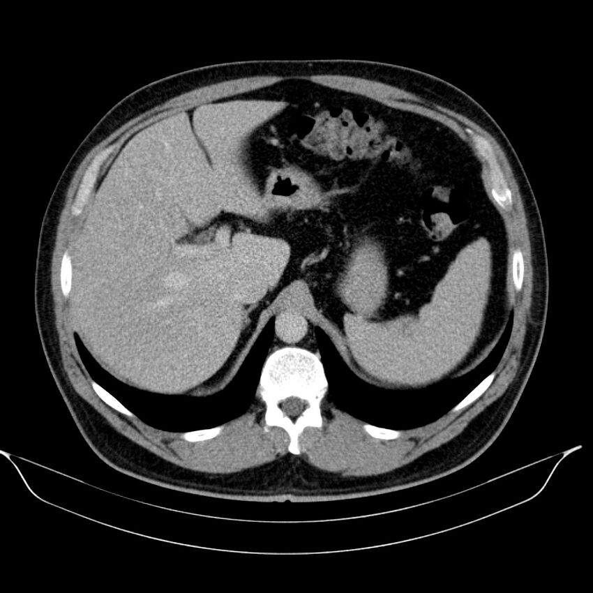 Neuroendocrine tumor of head of pancreas (Radiopaedia 57538-64502 D 21).jpg