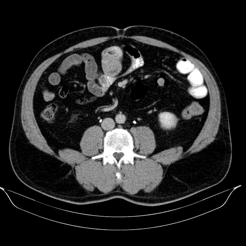 Neuroendocrine tumor of head of pancreas (Radiopaedia 57538-64502 D 48).jpg