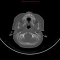 Non-accidental injury - bilateral subdural with acute blood (Radiopaedia 10236-10765 Axial bone window 3).jpg