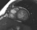 Non-compaction of the left ventricle (Radiopaedia 69436-79314 Short axis cine 102).jpg